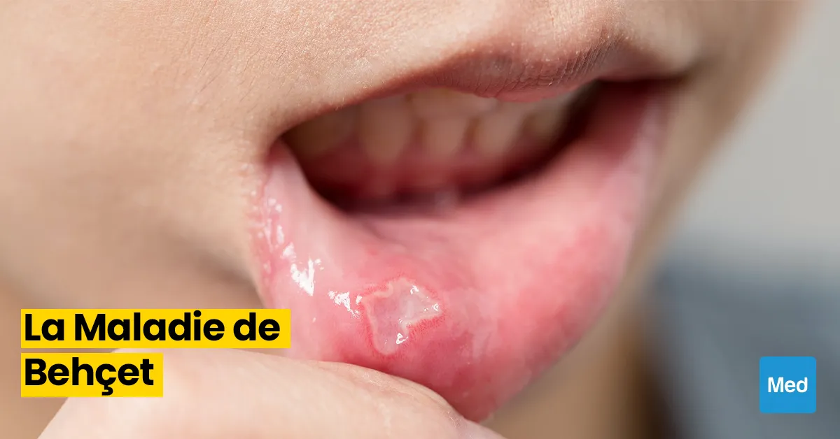 Comprendre la Maladie de Behçet : Symptômes, Diagnostic et Gestion